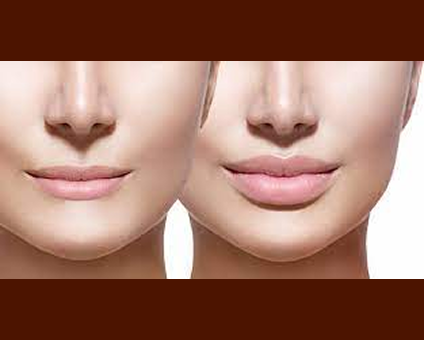 9 LIP AUGMENTATION 1