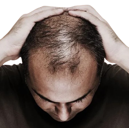 Hair_Loss_Solutions removebg preview