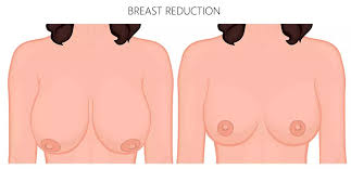 Breast Reduction