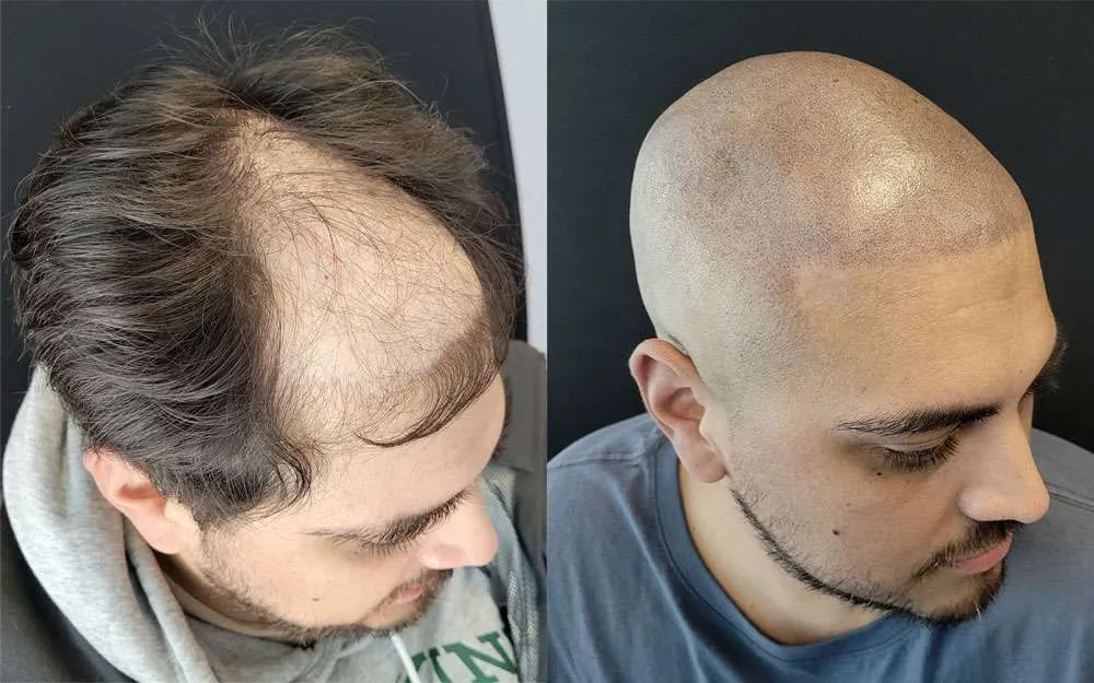 Scalp Micro Pigmentation
